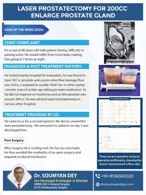 Laser prostatectomy performed for 200cc enlarged prostate by Dr Soumyan Dey