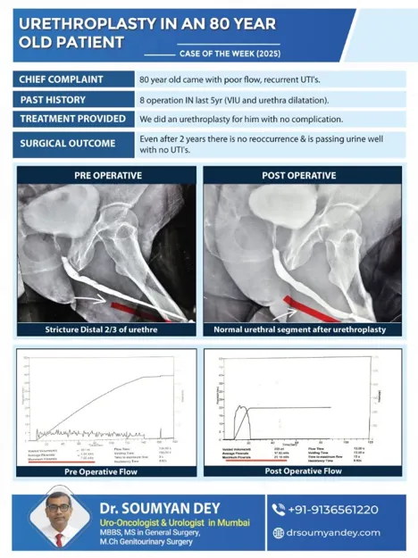 Urethroplasty for recurrent urethral stricture performed by Dr Soumyan Dey